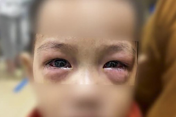 Nghỉ việc, cách ly cả nhà như thời COVID-19 vì đau mắt đỏ-1