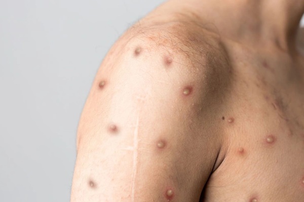 Ca đậu mùa khỉ phát hiện tại TP. Hồ Chí Minh: Chưa tìm thấy yếu tố liên hệ với nước ngoài-2