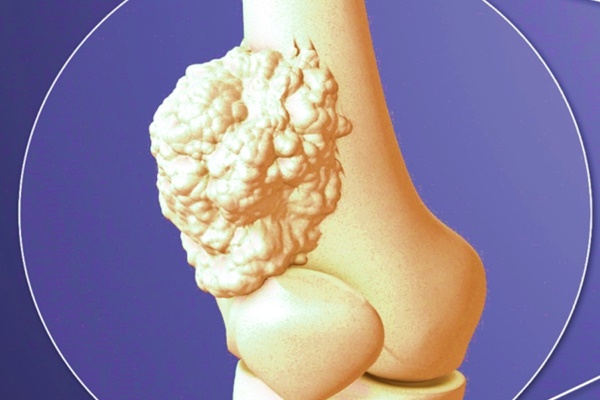 Trên cổ có 3 thay đổi này thì nên sớm đi tầm soát ung thư-4