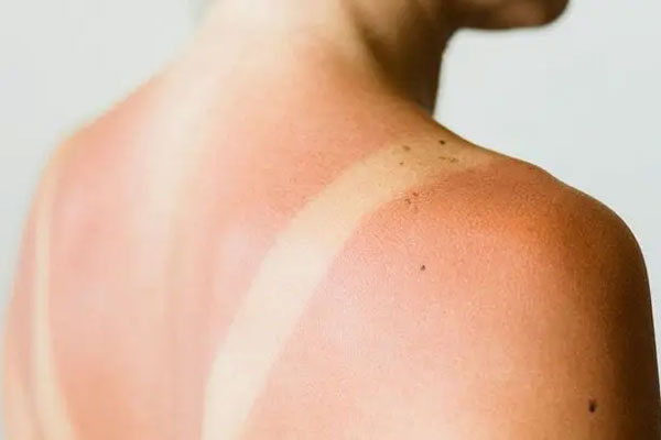 Mất bao lâu để da cháy nắng phục hồi?-1