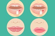 4 dấu hiệu bệnh nghiêm trọng có thể xuất hiện ở môi: Nếu thấy cần đi khám ngay