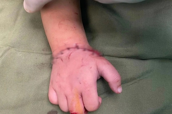Bé gần 18 tháng tuổi bị máy cắt đá của gia đình cắt đứt lìa bàn tay-2