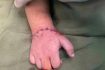 Bé gần 18 tháng tuổi bị máy cắt đá của gia đình cắt đứt lìa bàn tay