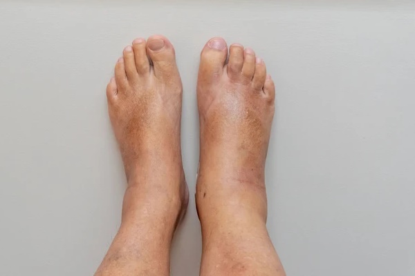 Màu móng tay có thể phản ánh tình trạng thận, bác sĩ hướng dẫn cách quan sát để nắm bắt tình hình sức khỏe-5