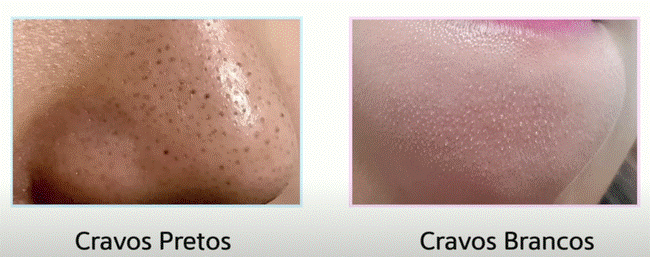 Cách lấy nhân mụn đầu đen tại nhà hiệu quả mà không làm hại da-1