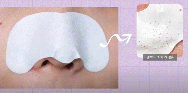 Cách lấy nhân mụn đầu đen tại nhà hiệu quả mà không làm hại da-2