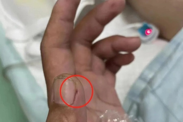 Bé trai mắc viêm màng não nặng do vi khuẩn phế cầu-2