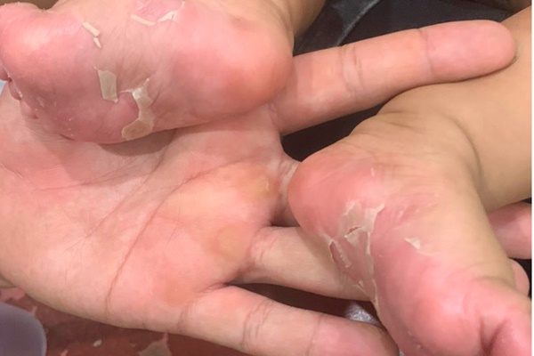 Cô gái cùng lúc mắc sùi mào gà, giang mai dù 2 năm không làm chuyện ấy”-4