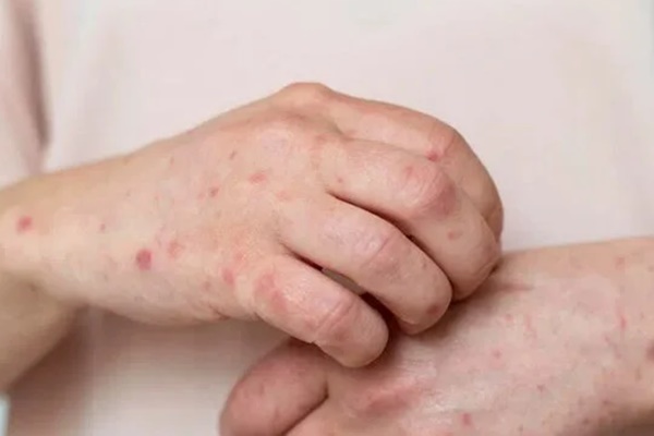 TP Hồ Chí Minh ghi nhận 4 ca đậu mùa khỉ trong một ngày-3