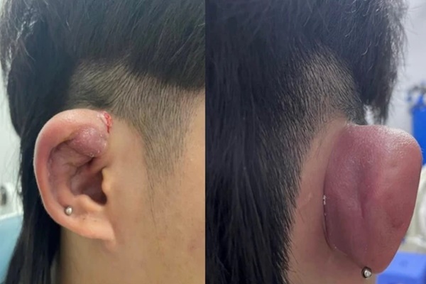 Hoại tử mi mắt vì spa tiêm ống oxy già tẩy trắng răng để làm đẹp-3