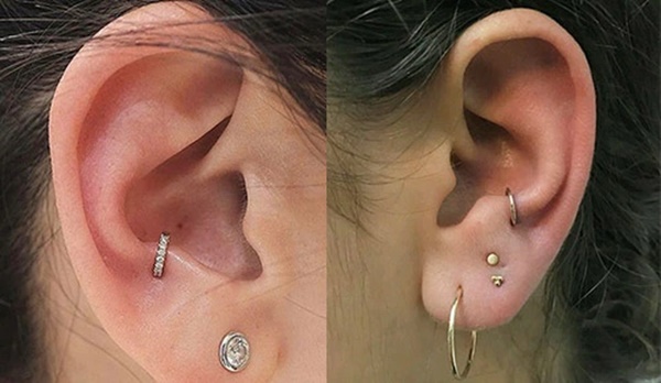 Nhiễm trùng, hoại tử sụn do bấm nhiều lỗ tai-2