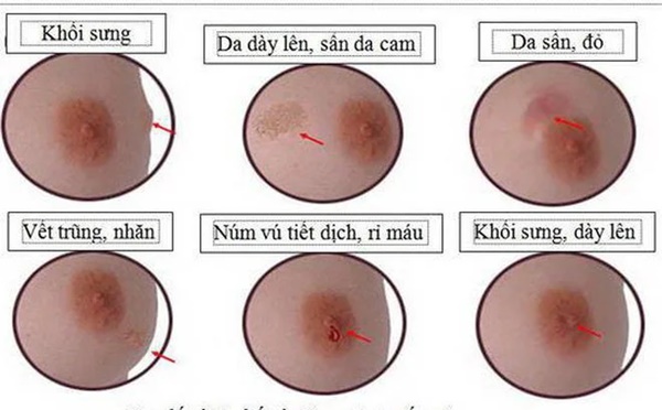 8 dấu hiệu cảnh báo khả năng có khối u đang phát triển trong ngực-2