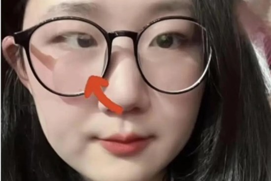 Cô gái bỗng nhiên bị lác mắt vì thú vui của nhiều người