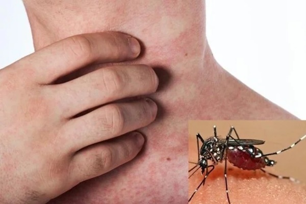 Hà Nội: Gần 3000 người đang nằm viện vì... muỗi-4