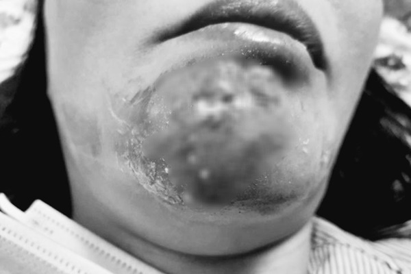 Nữ sinh 22 tuổi bị hỏng da mặt vì tự peel tại nhà-2