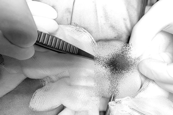 Bé trai 2 tuổi phải cắt tinh hoàn vì bệnh thường gặp