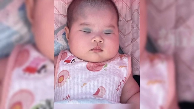 Em bé chào đời với vết bớt độc nhất vô nhị trên mặt, cư dân mạng đùa rằng: Bé trang điểm để gặp mẹ-2