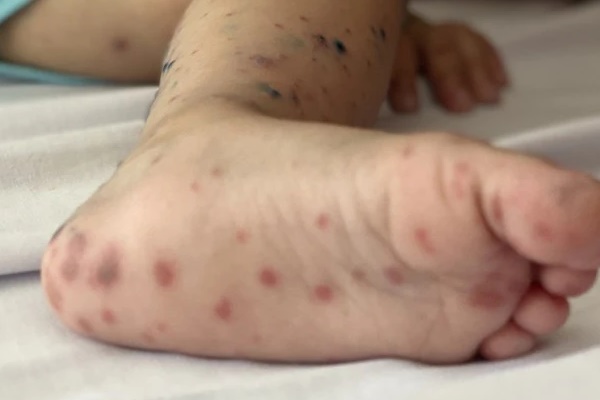 23 ca tử vong do tay chân miệng tại khu vực phía Nam-1