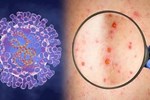 Người mắc đậu mùa khỉ đầu tiên tử vong ở Việt Nam nhiễm HIV-1