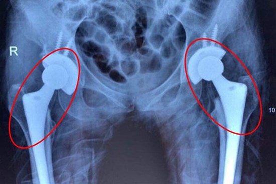 Nhiều người trẻ bị mục xương vì chất kích thích ai cũng dùng