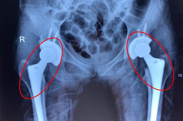 Nhiều người trẻ bị mục xương vì chất kích thích ai cũng dùng-1