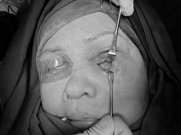 Hoại tử mi mắt vì spa tiêm ống oxy già tẩy trắng răng để làm đẹp-2