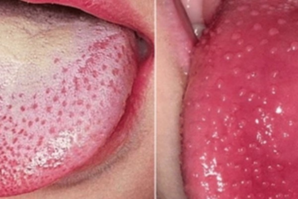 5 dấu hiệu ở lưỡi cảnh báo cả loạt bệnh nguy hiểm đang cận kề, từ bệnh gan, đột quỵ tới ung thư-2