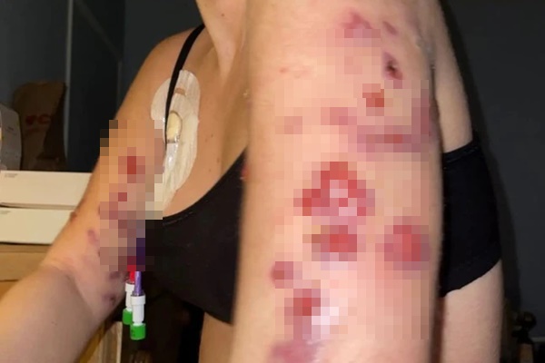 Lở loét toàn thân vì nhiễm virus ăn thịt người sau khi tiêm thuốc giảm béo-2