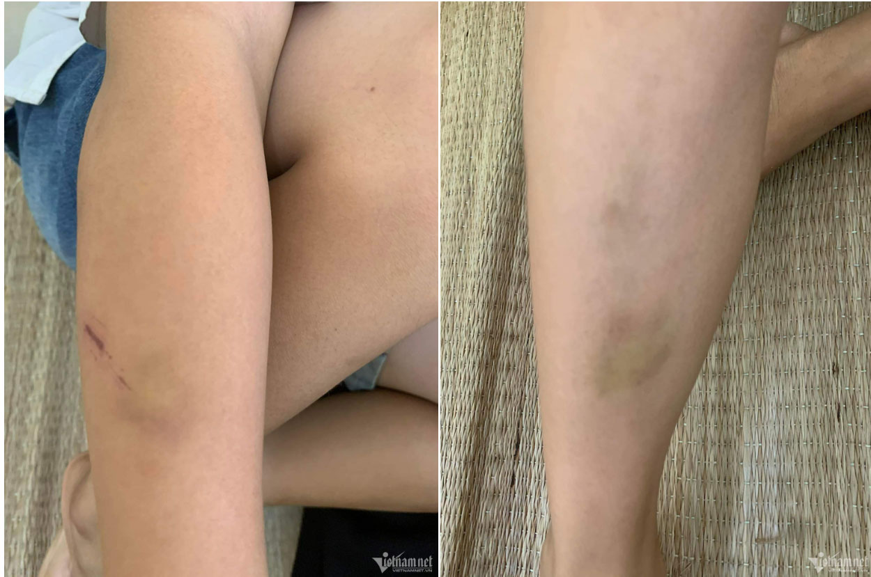 Tận cùng nỗi đau khi có con bị đánh đến hoảng loạn, gọi bố mẹ là côn đồ tốt-2