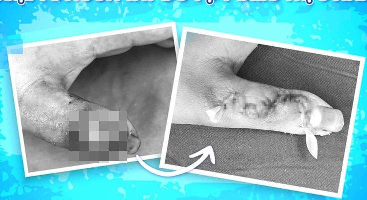 Đắp thuốc lá của thầy lang để chữa nhọt, bé trai suýt mất ngón tay-1