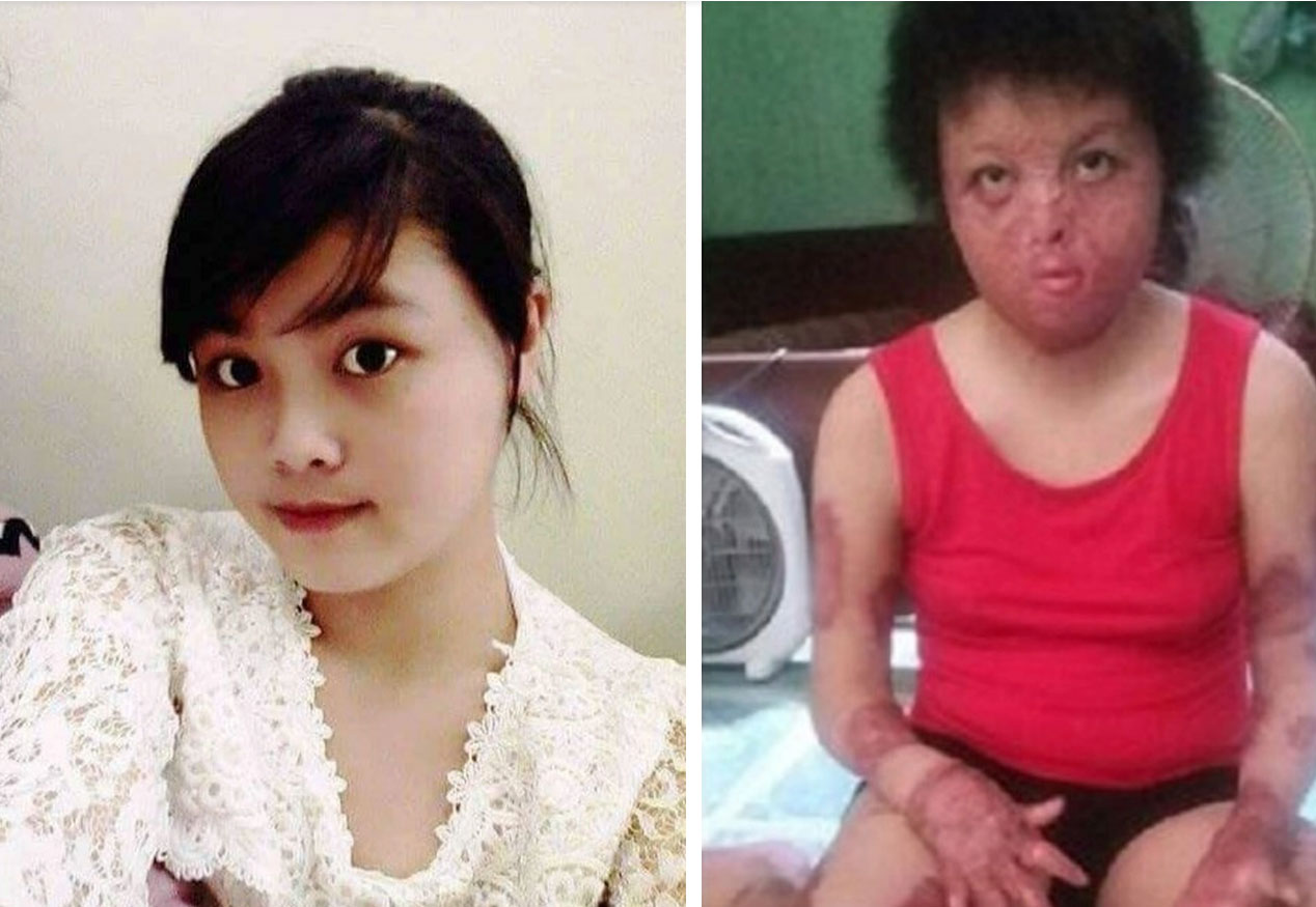 Sau 7 năm, cô gái Hà Nội bị chồng cũ tẩm xăng thiêu sống giờ ra sao?-2