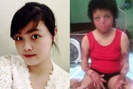 Sau 7 năm, cô gái Hà Nội bị chồng cũ tẩm xăng thiêu sống giờ ra sao?