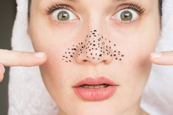 Nặn mụn đầu đen ở mũi thế nào cho đỡ hại da?-1