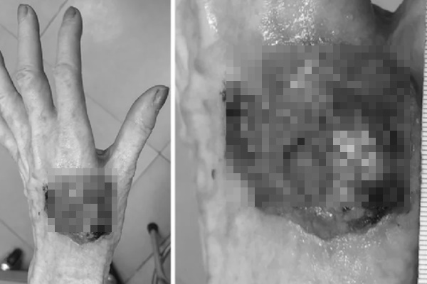 Nguy cơ ung thư da ở người bệnh bạch tạng-1