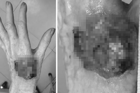 Nguy cơ ung thư da ở người bệnh bạch tạng