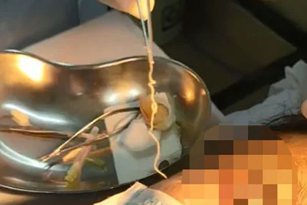 Phát hiện con giun dài 10cm trong mắt người phụ nữ-1