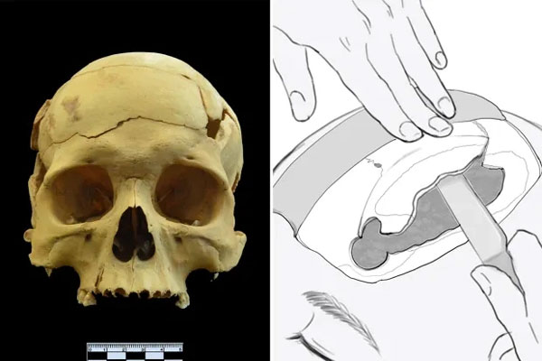 Phát hiện ca phẫu thuật mổ sọ kỳ lạ cách đây 2.700 năm, trước cả thời danh y Hoa Đà-4