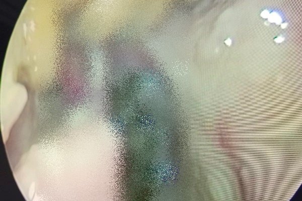 Gắp hơn 100 con giòi làm tổ trong mũi bệnh nhân-2