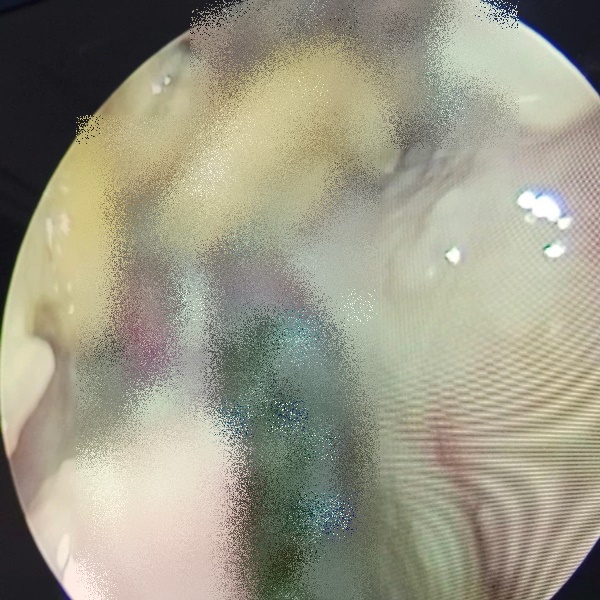 Ổ giòi hàng chục con làm tổ trong mũi bệnh nhân-1