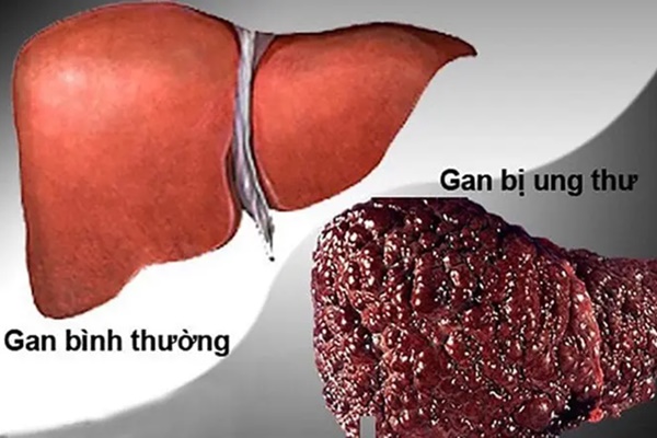 5 dấu hiệu cảnh báo ung thư gan sớm, mơ hồ cũng không nên bỏ qua-1