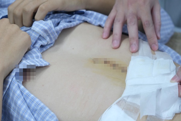 Hay bỏ bữa ăn và thức khuya, nam sinh 16 tuổi ói ra máu nguy kịch-2