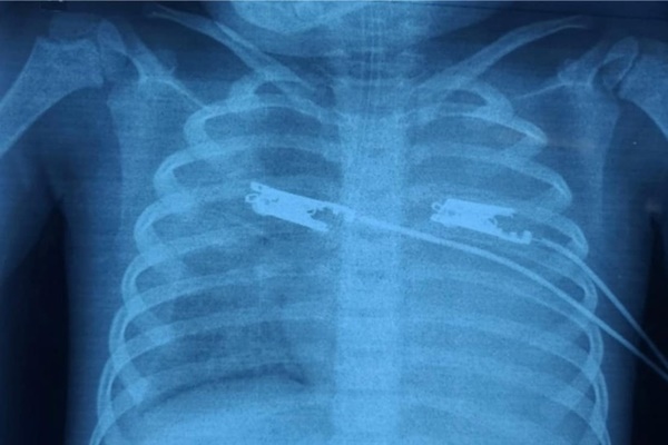 2 người bị suy hô hấp, tổn thương gan thận nặng vì sốt mò mà không biết-3