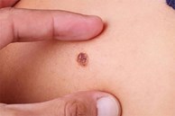 Chủ quan với nốt ruồi, một phụ nữ phát hiện ung thư hắc tố, chuyên gia chỉ rõ nốt ruồi có dấu hiệu này cần được khám sớm!