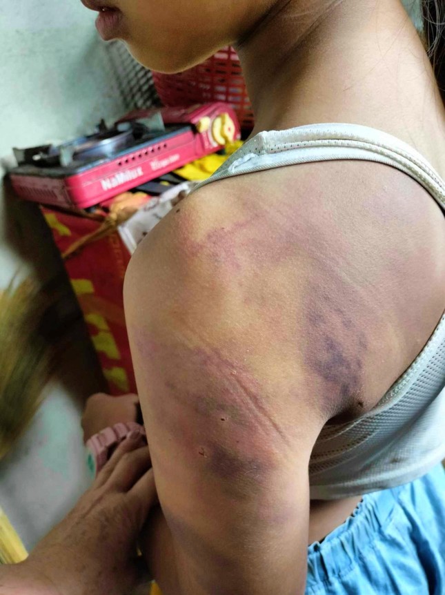 Nữ sinh lớp 4 bị 10 bạn cùng lớp đánh hội đồng bầm tím khắp người-1