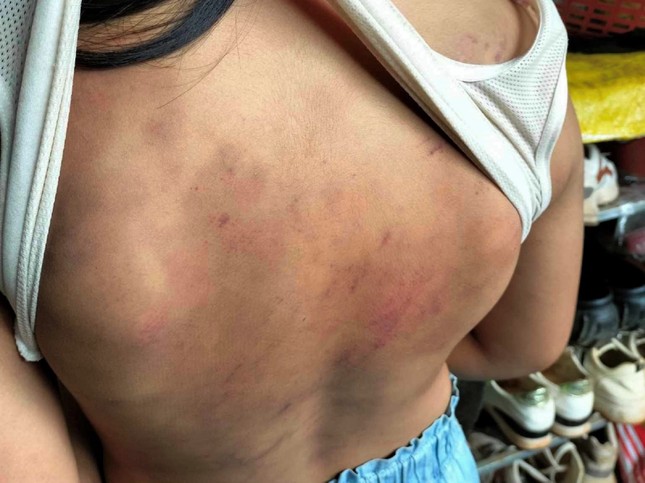 Nữ sinh lớp 4 bị 10 bạn cùng lớp đánh hội đồng bầm tím khắp người-2