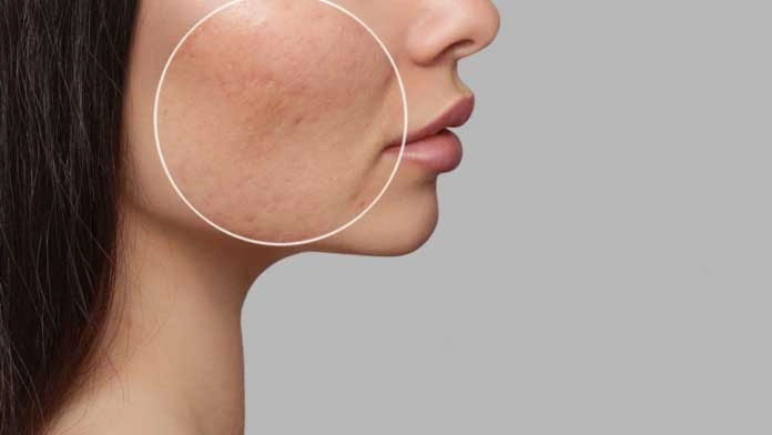 Nguyên nhân gây bít lỗ chân lông-1