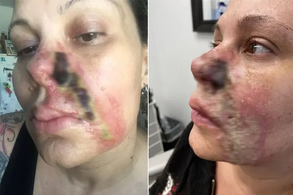 Nghiện tiêm filler, người phụ nữ bị mục nát và rụng một bên mũi-1