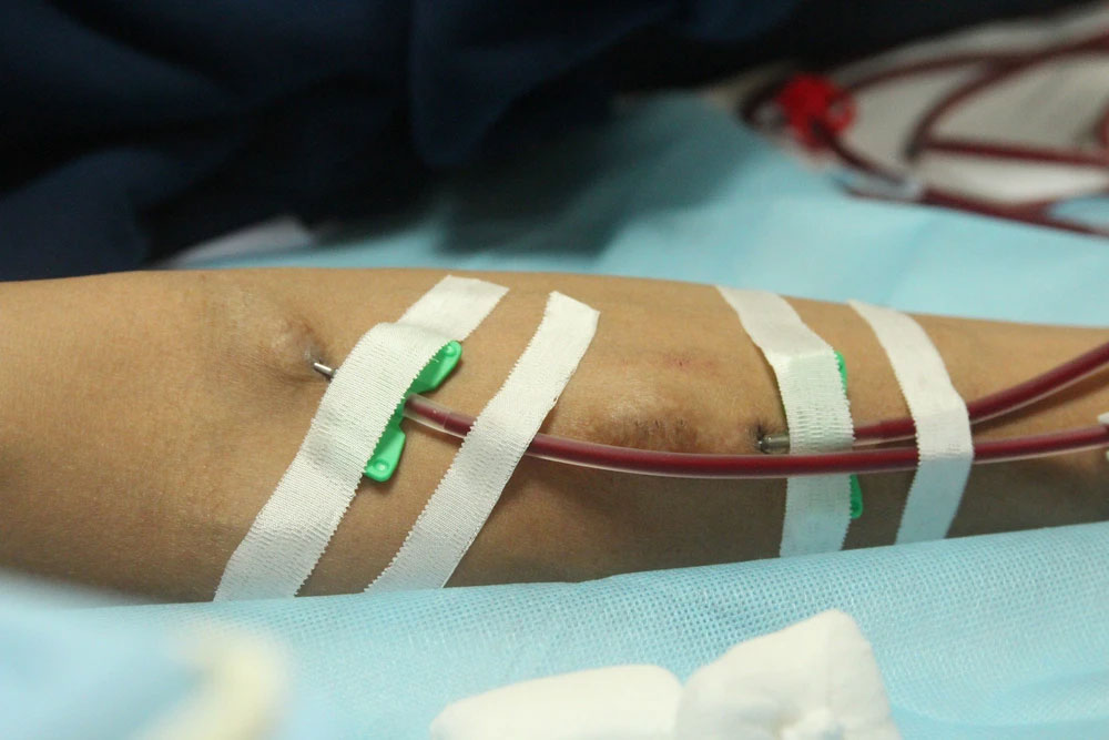 Nhiều người trẻ suy thận nhưng phát hiện rất muộn: 4 dấu hiệu cảnh báo ai cũng nên biết-1