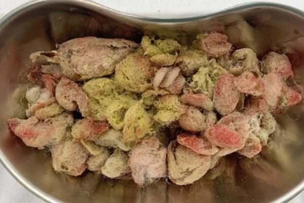 TPHCM: Nuốt lắc chân khi ngủ trưa ở trường, bé gái 5 tuổi lâm nguy-2