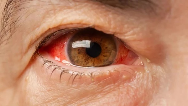 11 dấu hiệu ở mắt cảnh báo ung thư, dù có một trong số đó cũng phải đi khám ngay-2